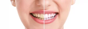 Teeth Whitening Craigieburn