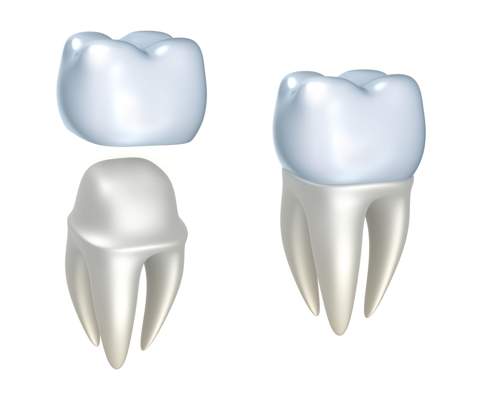 Crowns Vs Bridges:Which Is Right For You? | Dazzling Smiles Dental