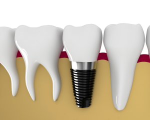 Dental-Implants-Craigieburn.png