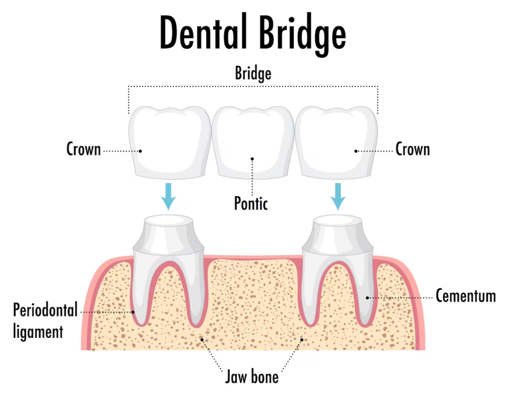 Dental Bridges- Dentist in Craigieburn