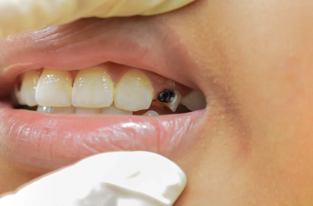 A woman indicating dental decay.