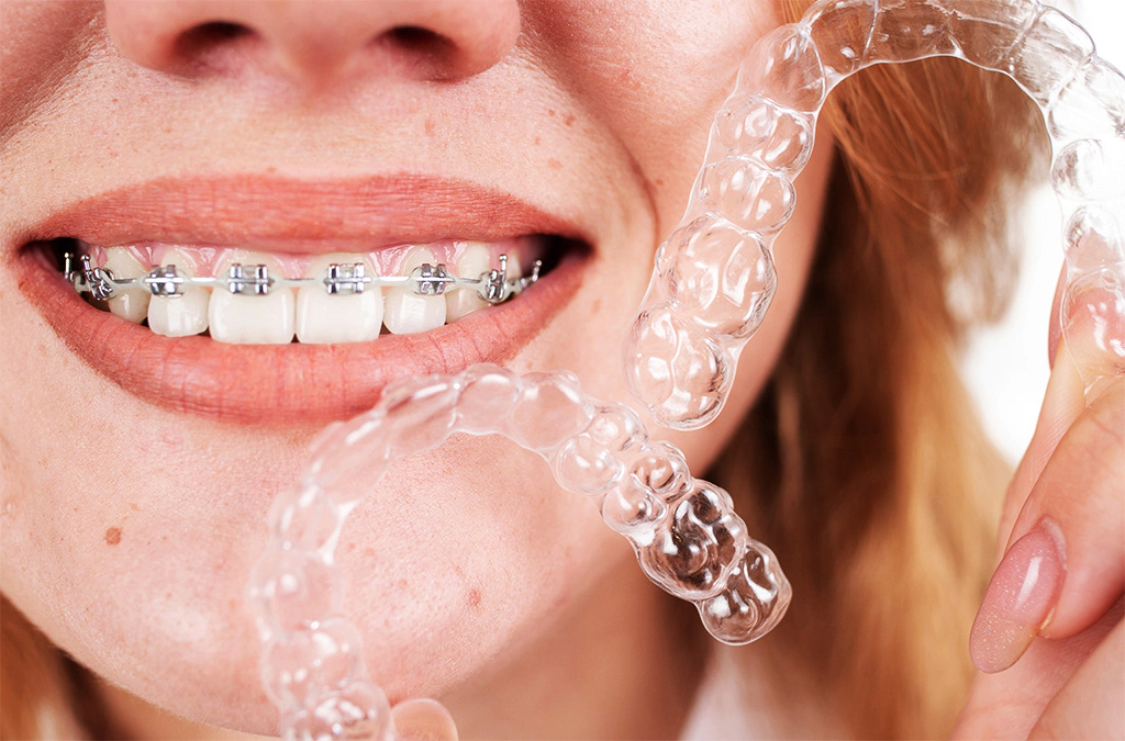Invisible Braces  Invisalign Clear Aligners - The Ultimate Guide
